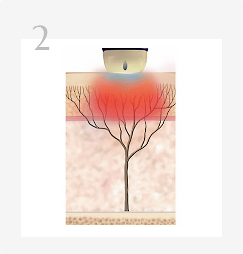 티타늄 시술방법